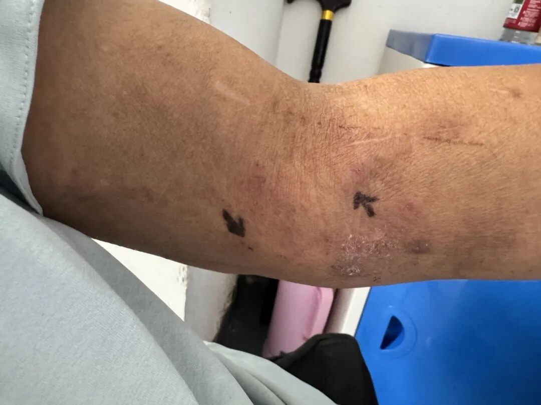 肾内医生通过吸脂术,让肾病患者造瘘有了新选择