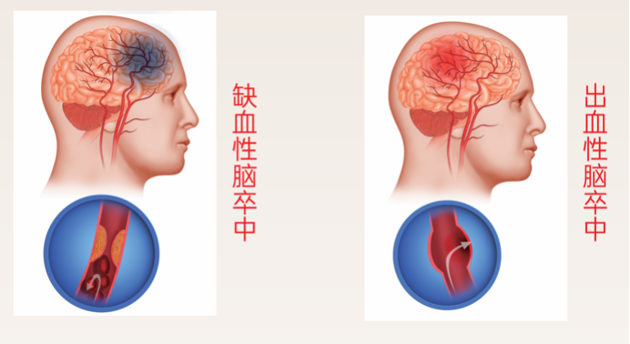 央视主持人离世敲响警钟:成人致死致残首位病因就是它!