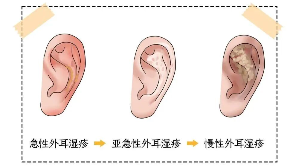 耳朵一圈为啥总有黄色油垢,刮一下能有满满一指甲?