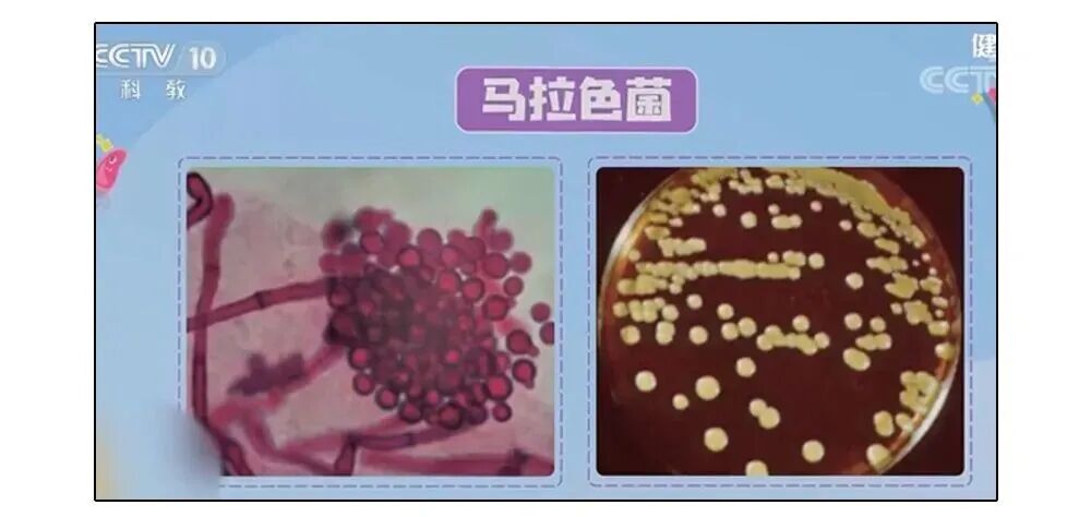 耳朵一圈为啥总有黄色油垢,刮一下能有满满一指甲?