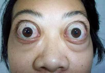 【二附院医生说】眼睛瞪得像铜铃, 警惕甲亢突眼