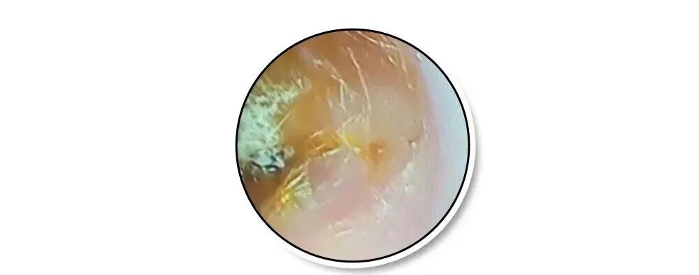 耳朵一圈为啥总有黄色油垢,刮一下能有满满一指甲?