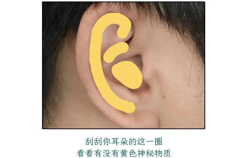 耳朵一圈为啥总有黄色油垢,刮一下能有满满一指甲?