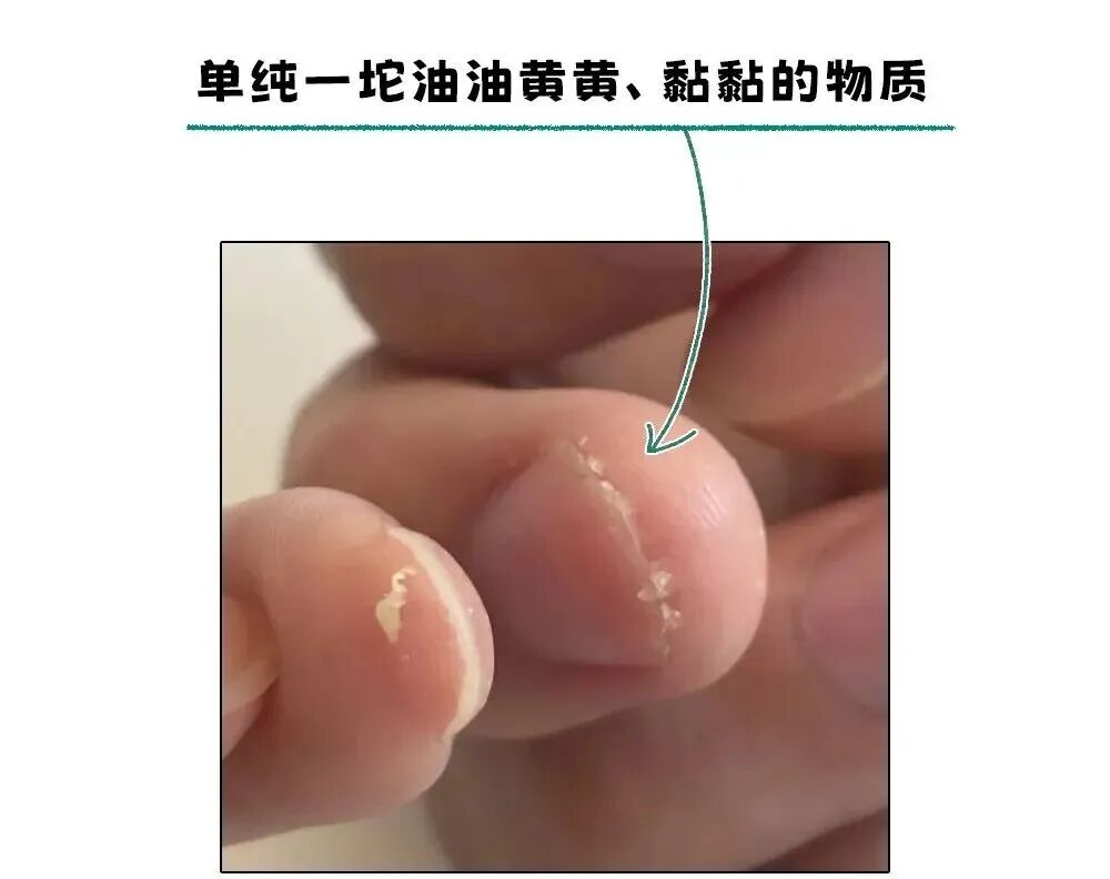 耳朵一圈为啥总有黄色油垢,刮一下能有满满一指甲?