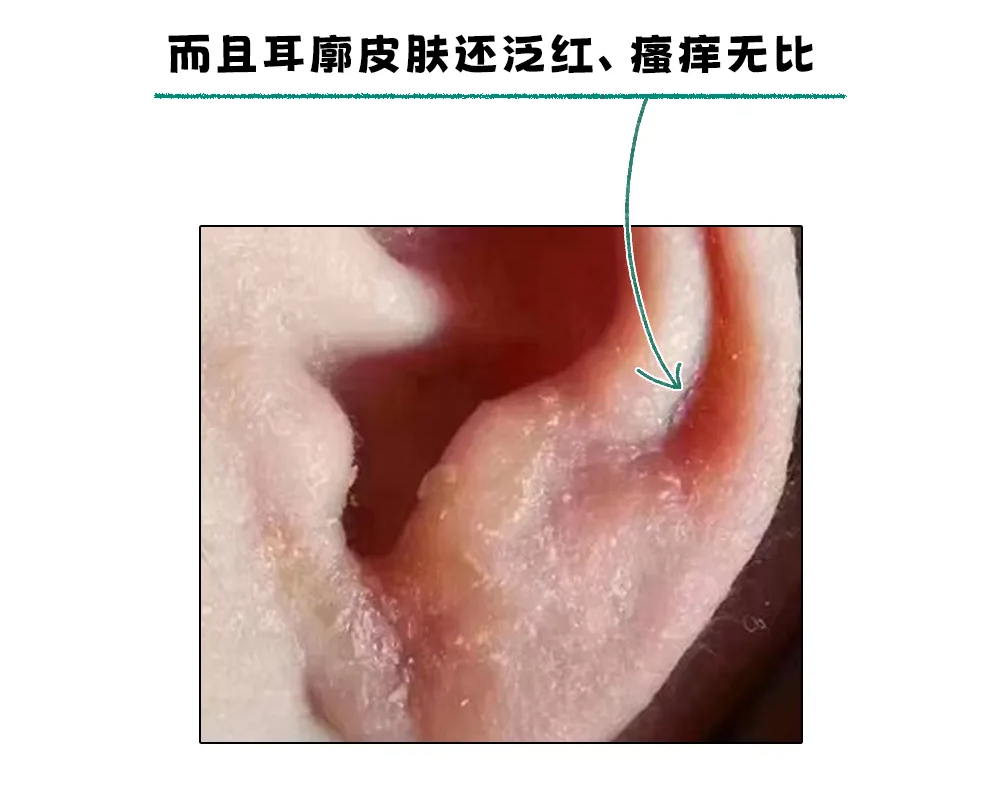 耳朵一圈为啥总有黄色油垢,刮一下能有满满一指甲?