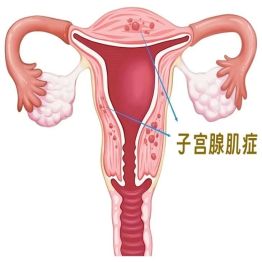 别再把腺肌症当宫寒！30+女性高发的“内膜钻墙”疾病