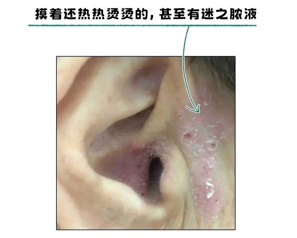 耳朵一圈为啥总有黄色油垢,刮一下能有满满一指甲?
