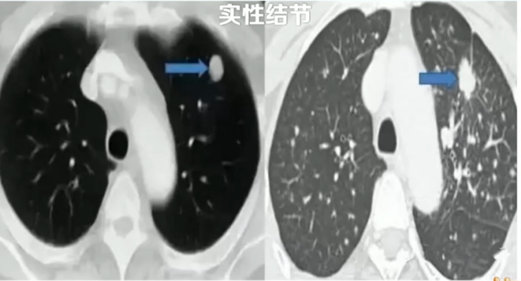 早期肺癌为何常“无声”?——浅谈早期肺癌的识别与筛查