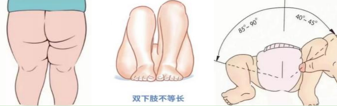宝宝为什么要做髋关节超声检查？