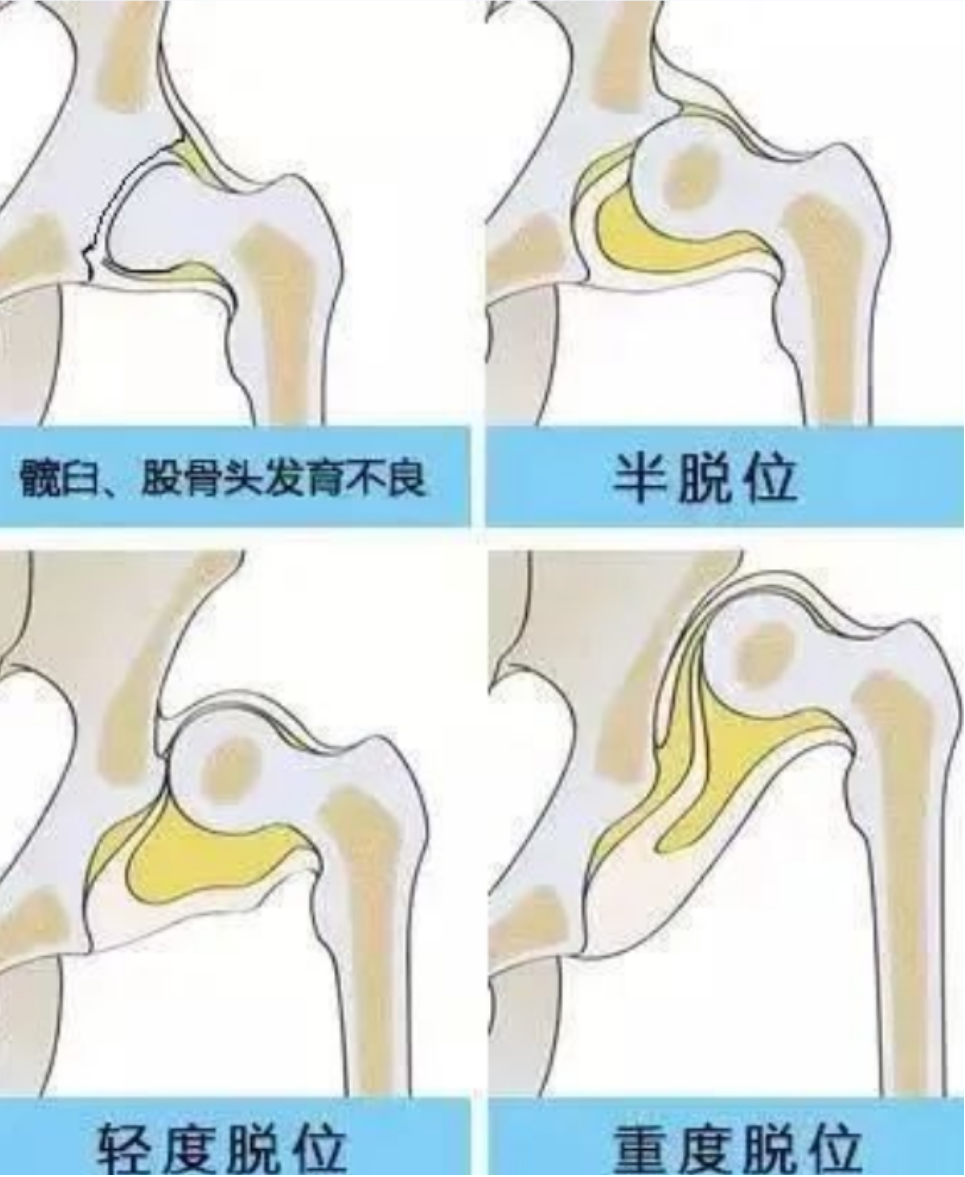 宝宝为什么要做髋关节超声检查？