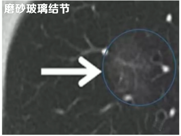 早期肺癌为何常“无声”?——浅谈早期肺癌的识别与筛查