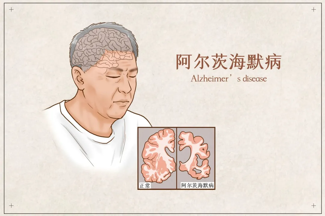【世界阿尔茨海默病日】1000万人患有痴呆症?有些“记性差”真不是老糊涂那么简单