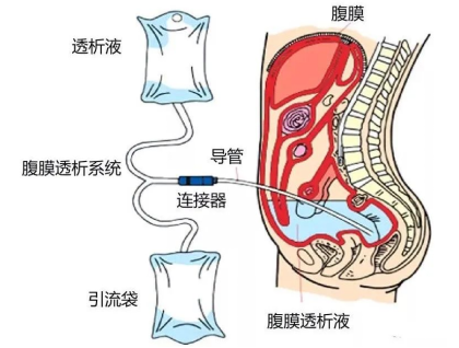 尿毒症不是终点,科学守护续航人生