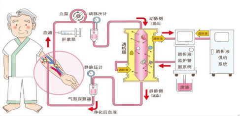 尿毒症不是终点,科学守护续航人生