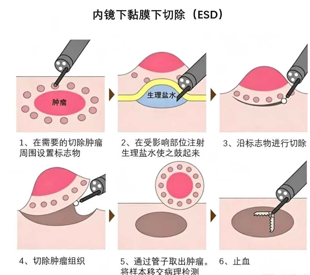 没症状真的不用做肠镜吗?警惕沉默的杀手——结直肠癌!