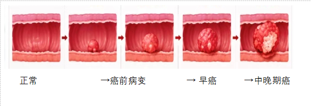 没症状真的不用做肠镜吗?警惕沉默的杀手——结直肠癌!