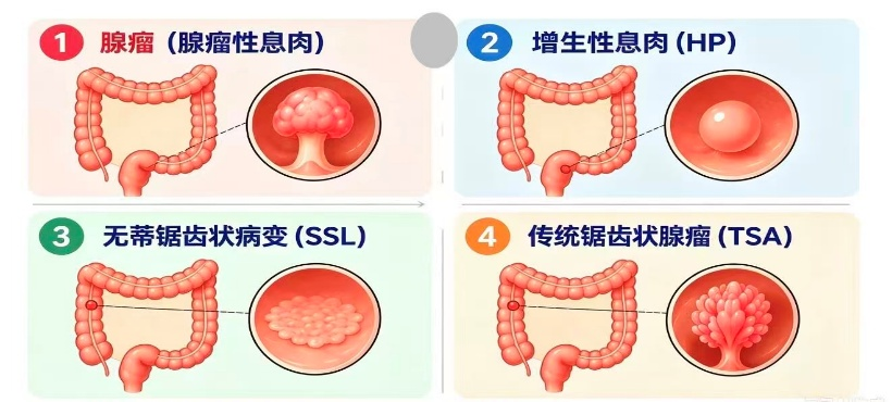 没症状真的不用做肠镜吗?警惕沉默的杀手——结直肠癌!