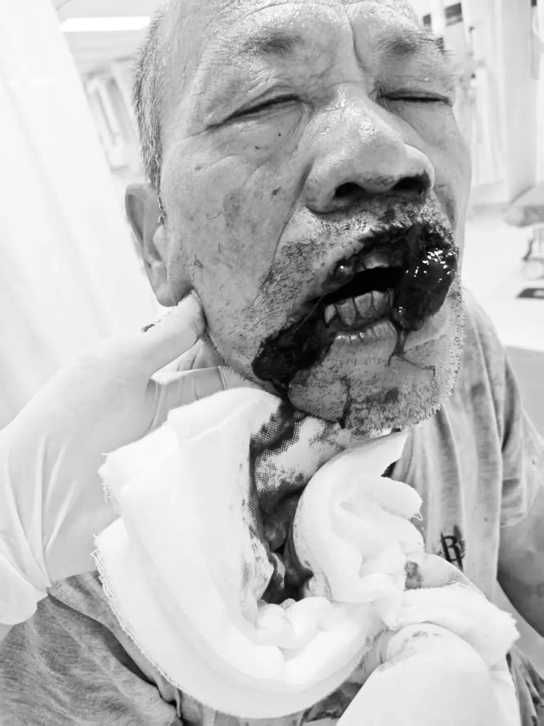角磨机意外割伤面部，18厘米伤口一个月能恢复成什么样？