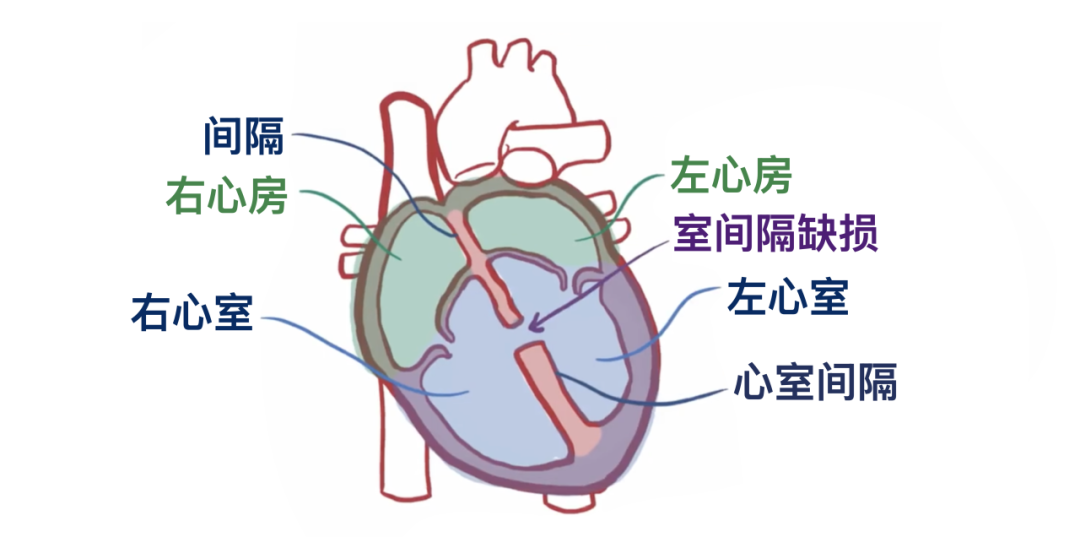 一“孔”之隔，微创“补心”——我院心脏大血管外科成功完成经皮室间隔缺损封堵术