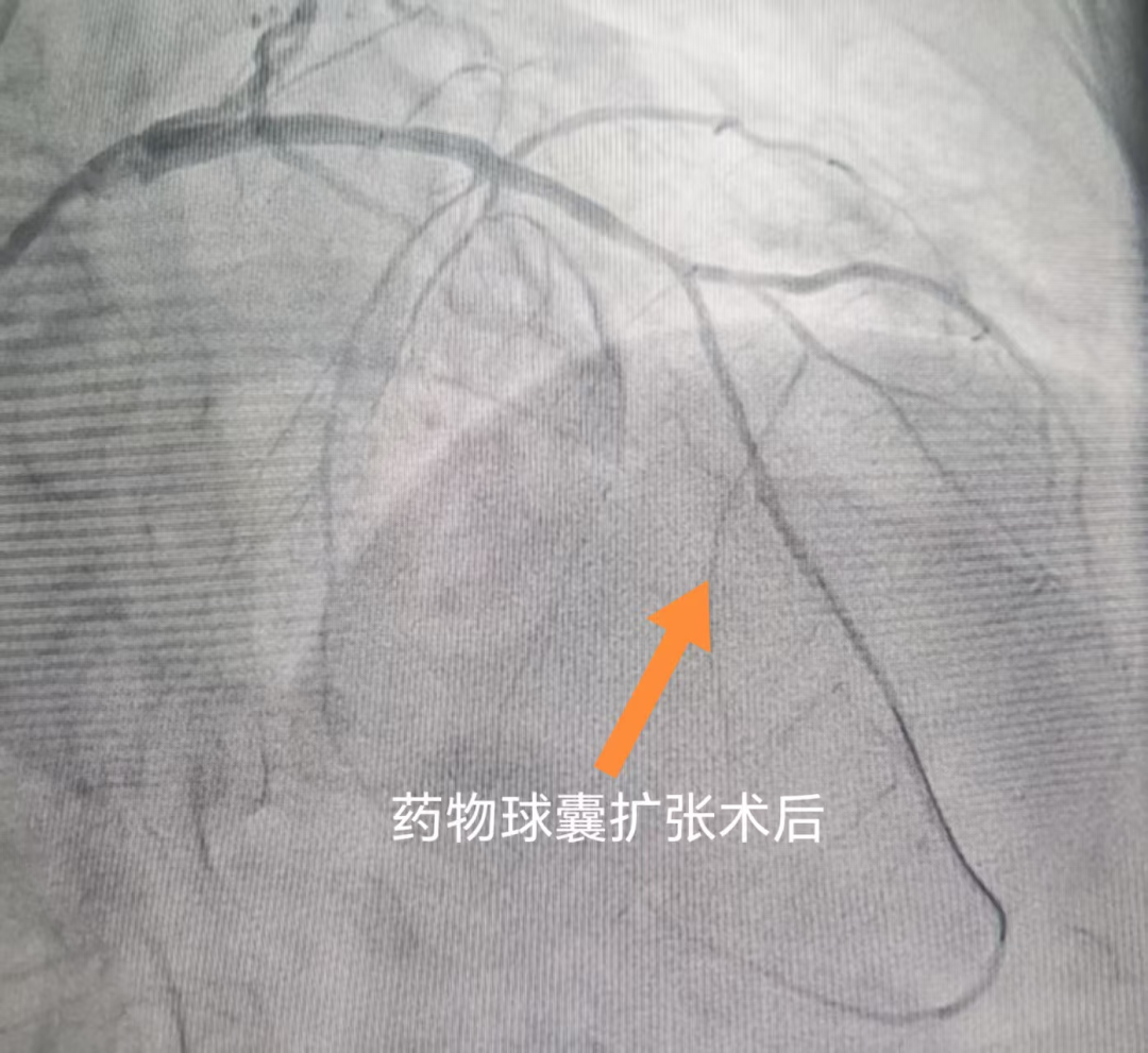 生死一线显担当:八十岁心衰老人的"生命通道"被成功打通——河科大二附院心内一病区成功完成高龄危重患者前降支CTO病变介入治疗