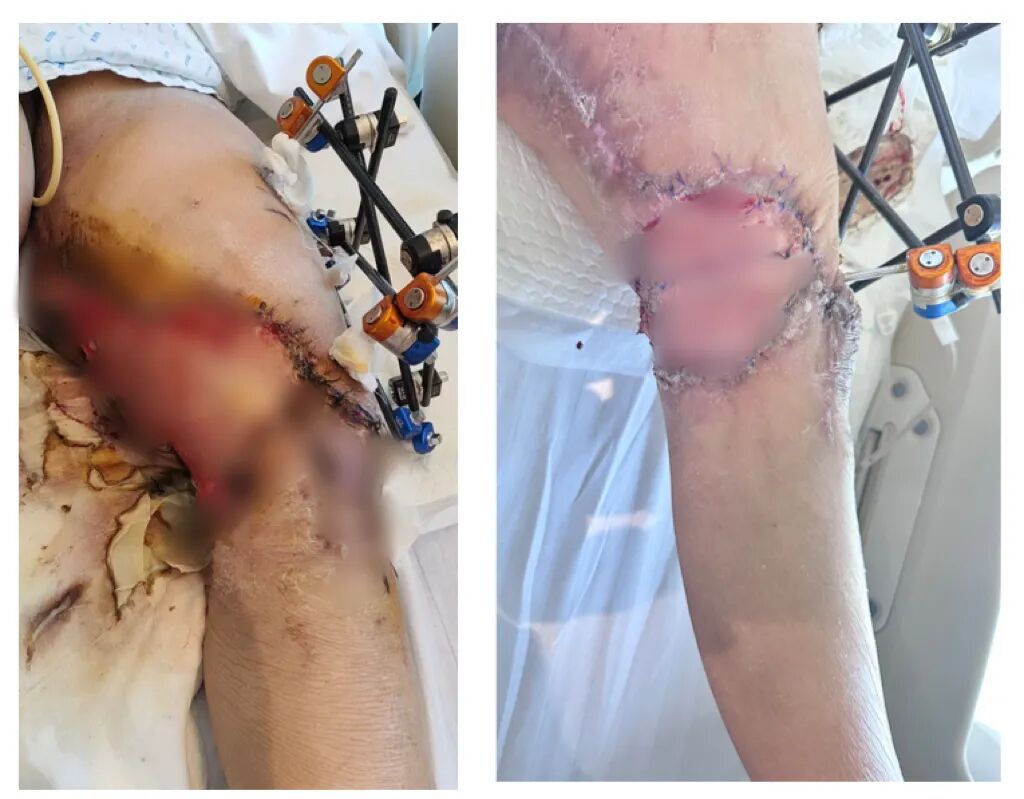 车祸致股骨远端骨折术后皮肤坏死 国文医院骨科多次手术完成创面修复