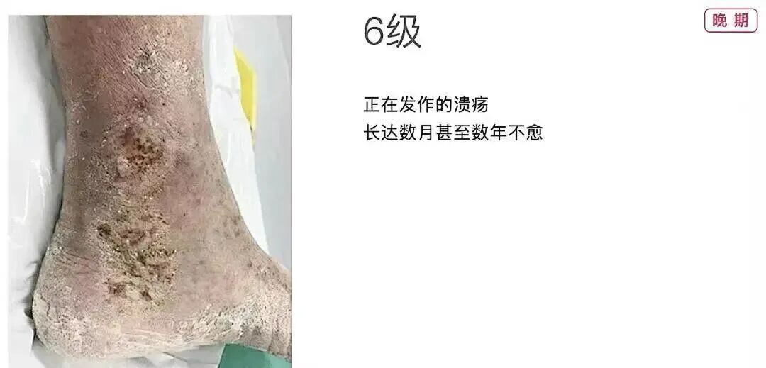 技术在线|突破 300 例!本溪市中心医院下肢静脉曲张射频消融微创技术成熟落地