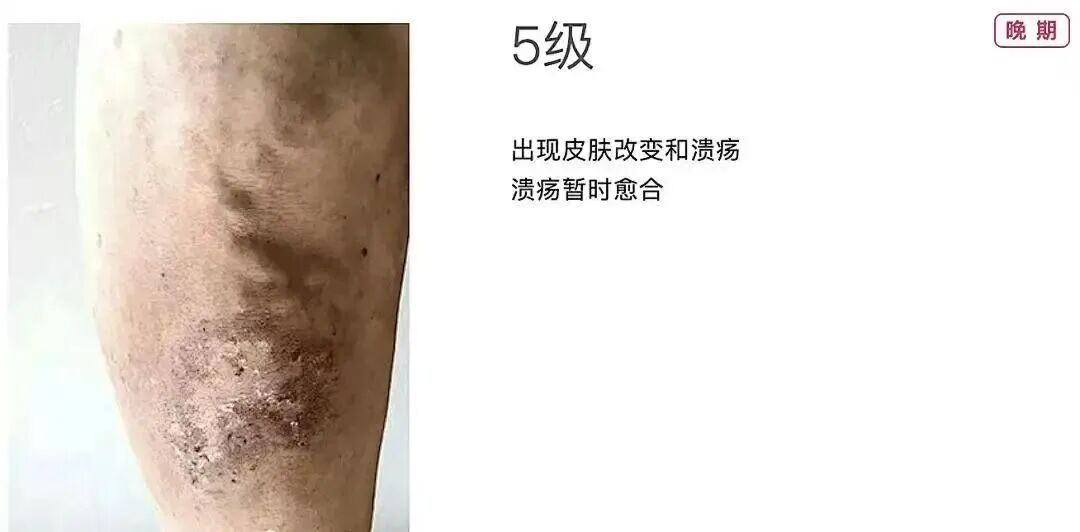 技术在线|突破 300 例!本溪市中心医院下肢静脉曲张射频消融微创技术成熟落地