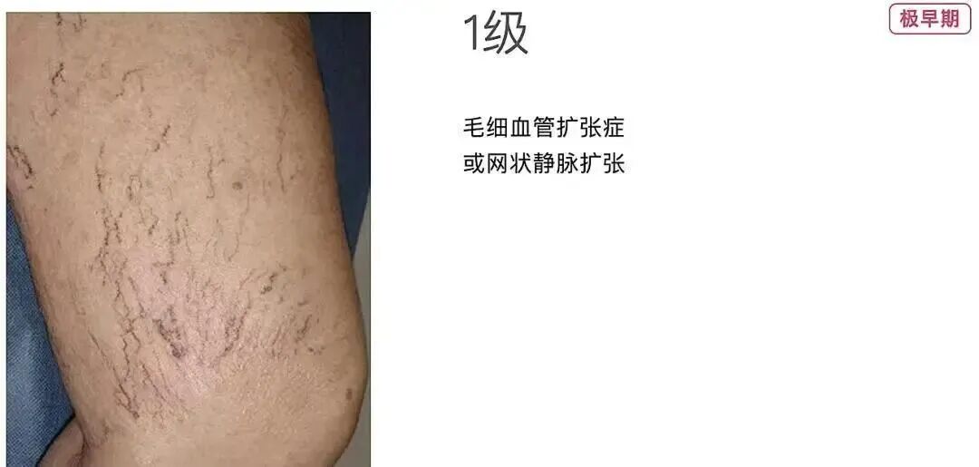 技术在线|突破 300 例!本溪市中心医院下肢静脉曲张射频消融微创技术成熟落地