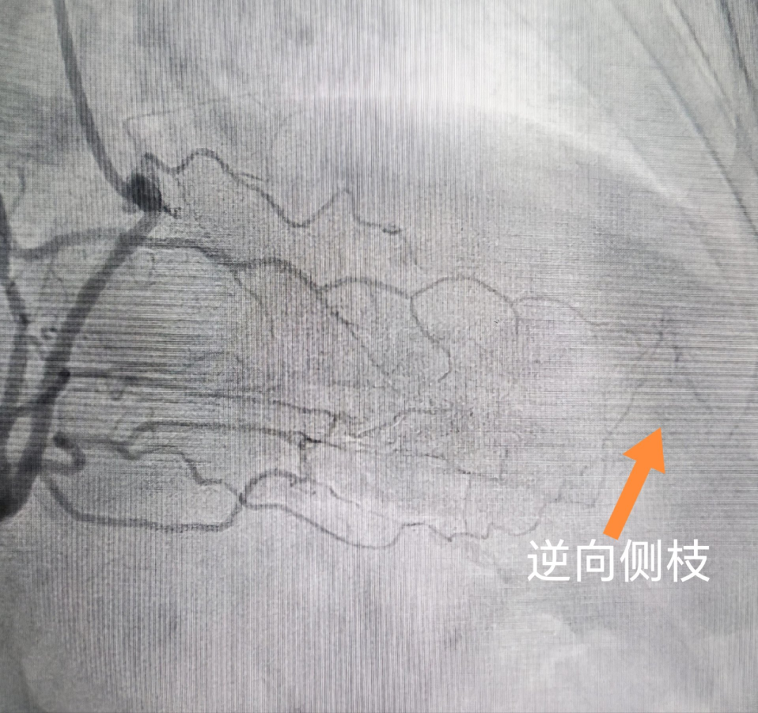 生死一线显担当:八十岁心衰老人的"生命通道"被成功打通——河科大二附院心内一病区成功完成高龄危重患者前降支CTO病变介入治疗