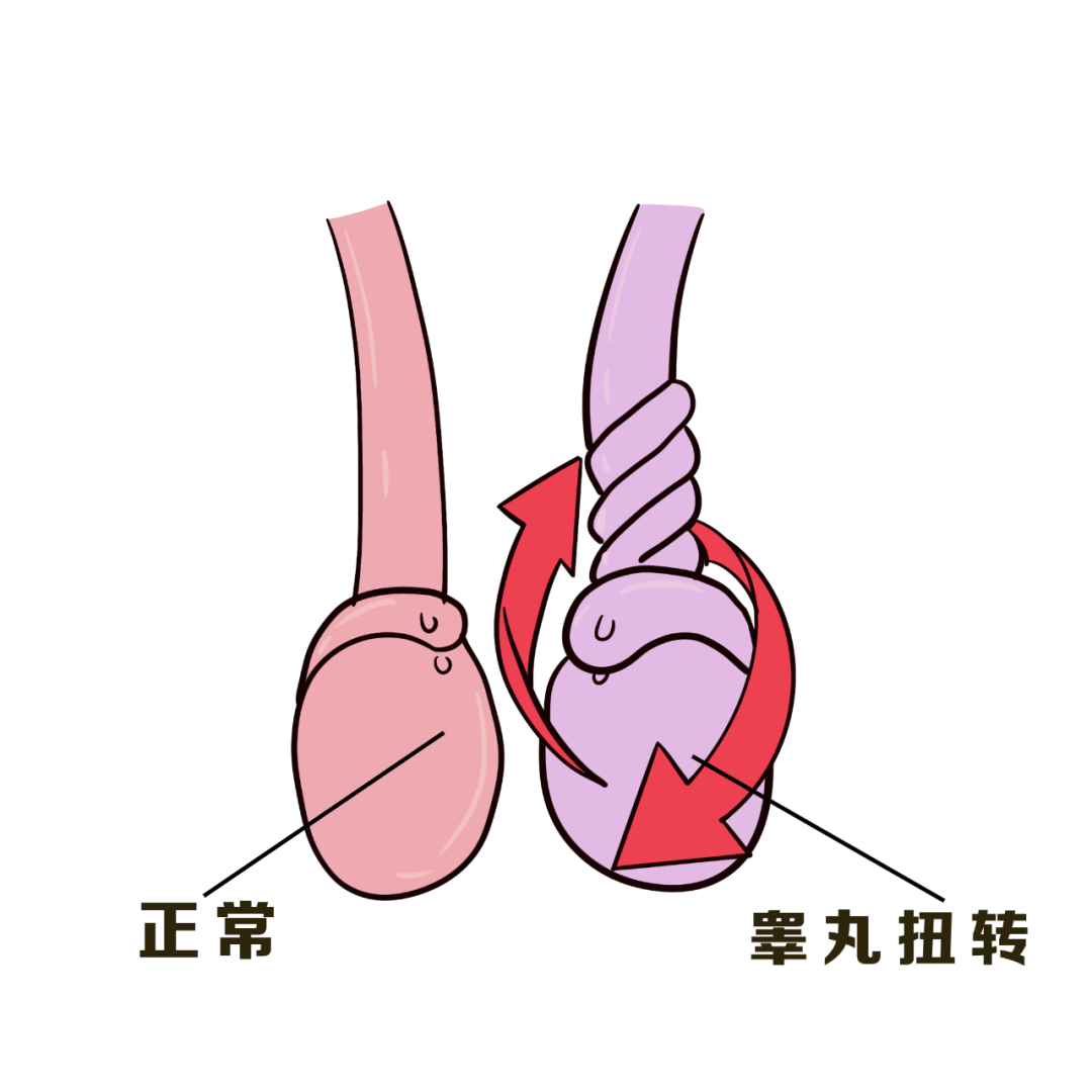 关于睾丸扭转,每个男性都该知道的6小时