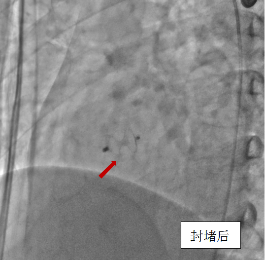 一“孔”之隔，微创“补心”——我院心脏大血管外科成功完成经皮室间隔缺损封堵术