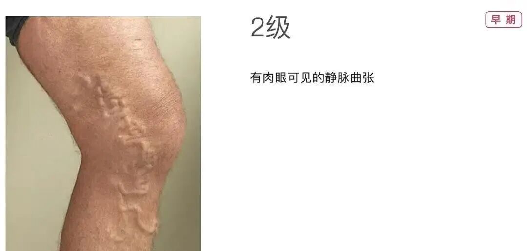 技术在线|突破 300 例!本溪市中心医院下肢静脉曲张射频消融微创技术成熟落地
