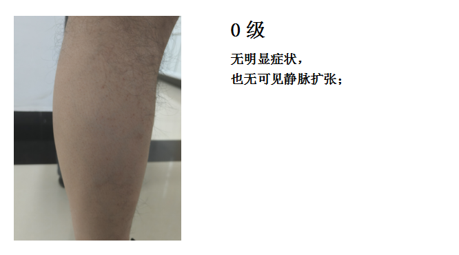 技术在线|突破 300 例!本溪市中心医院下肢静脉曲张射频消融微创技术成熟落地