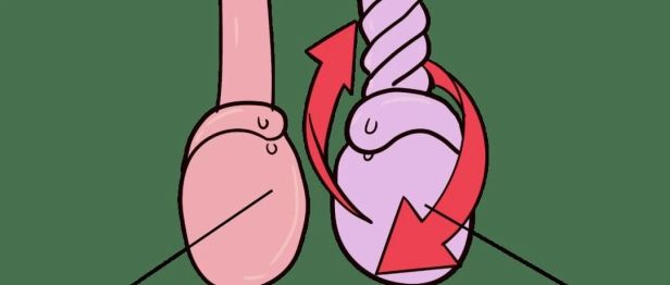 关于睾丸扭转，每个男性都该知道的6小时