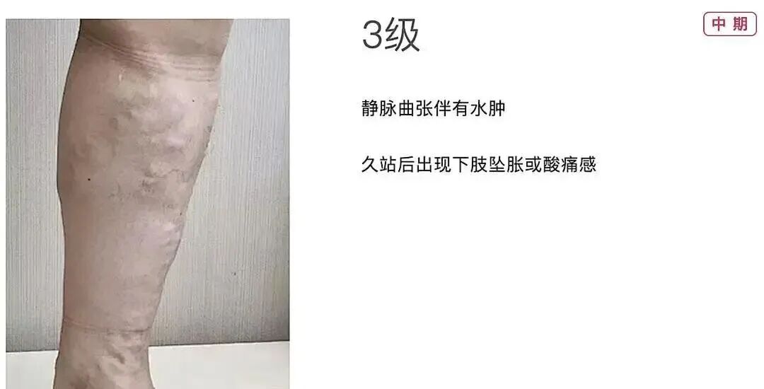 技术在线|突破 300 例!本溪市中心医院下肢静脉曲张射频消融微创技术成熟落地
