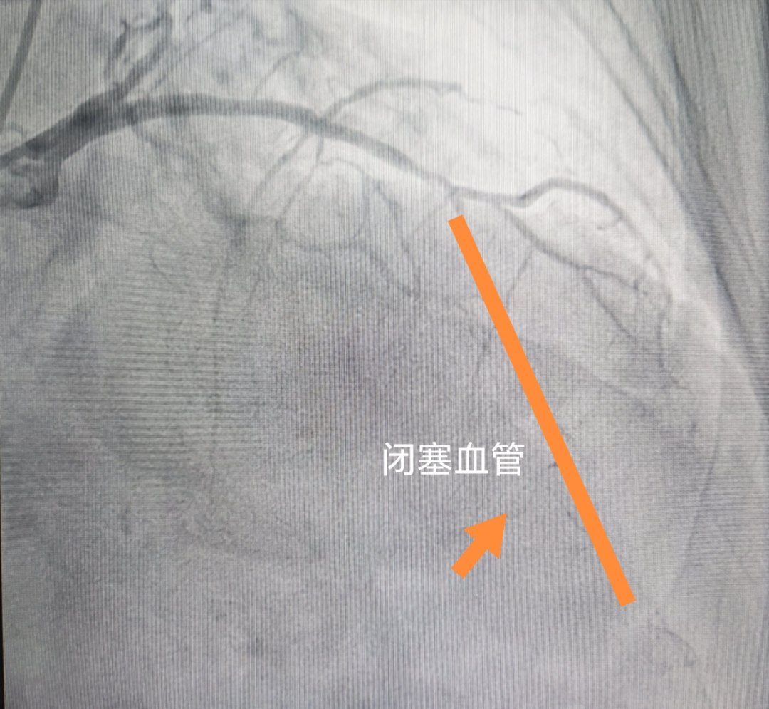 生死一线显担当:八十岁心衰老人的"生命通道"被成功打通——河科大二附院心内一病区成功完成高龄危重患者前降支CTO病变介入治疗