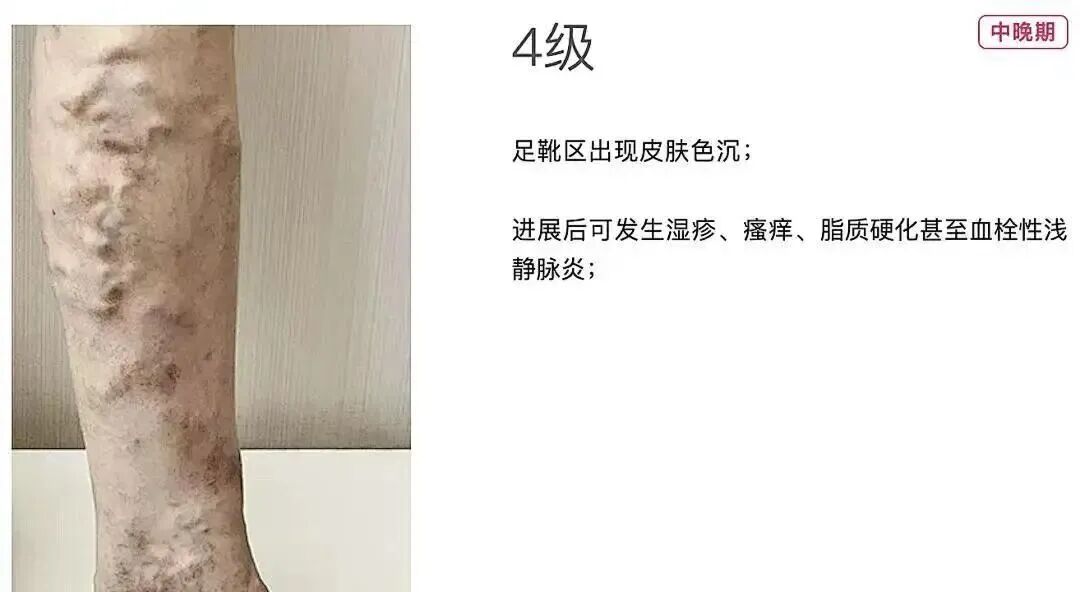 技术在线|突破 300 例!本溪市中心医院下肢静脉曲张射频消融微创技术成熟落地