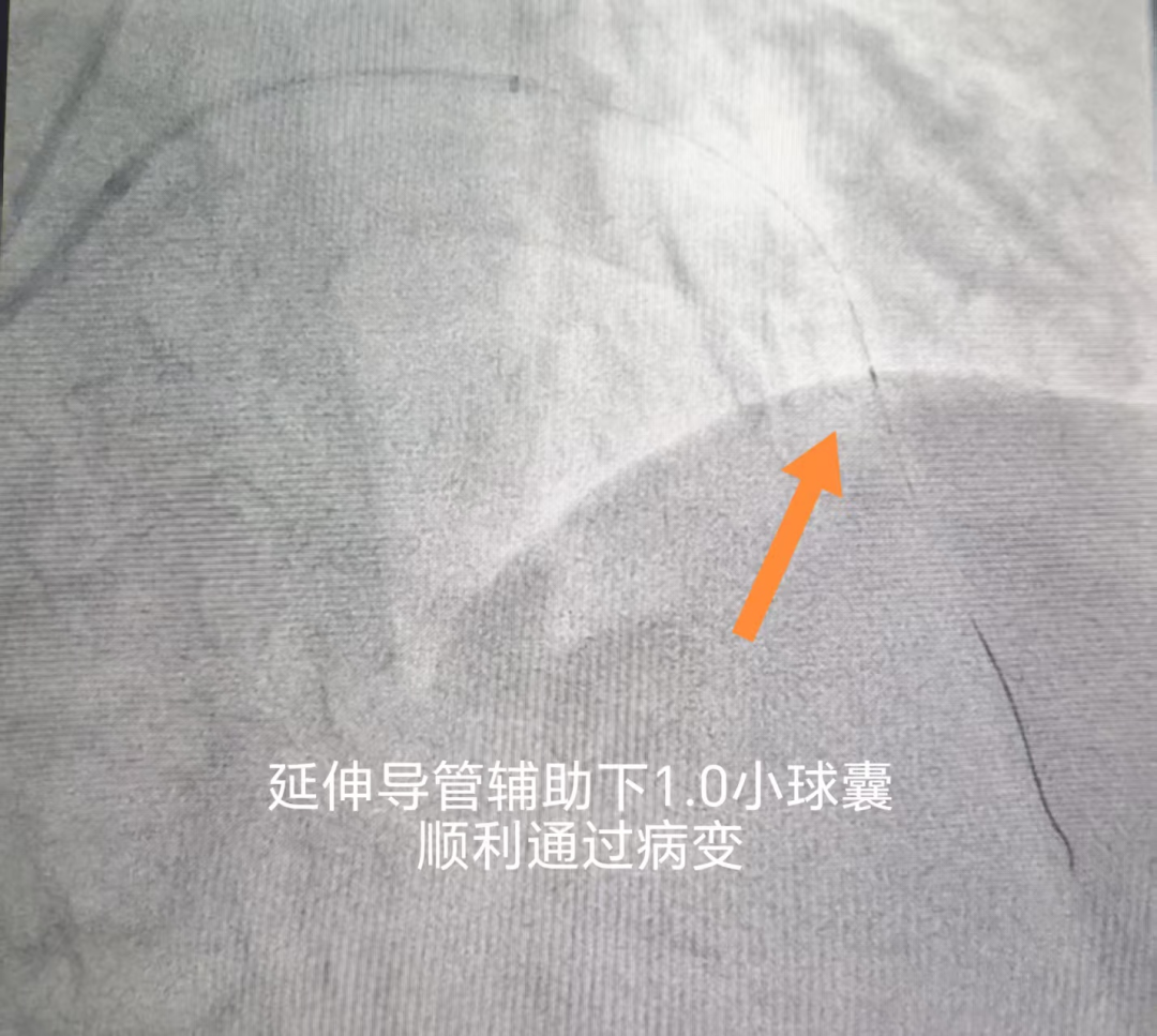 生死一线显担当:八十岁心衰老人的"生命通道"被成功打通——河科大二附院心内一病区成功完成高龄危重患者前降支CTO病变介入治疗
