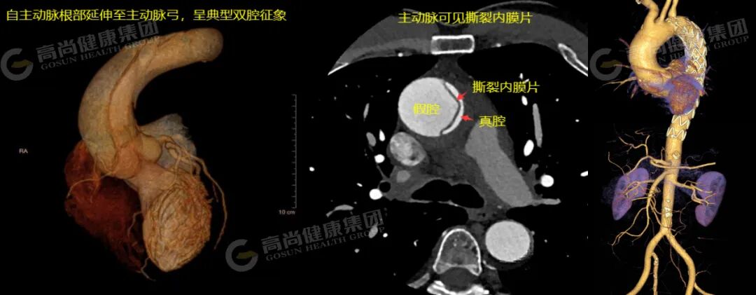 为什么医生建议你做一次全身血管CTA检查?