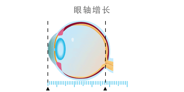 为什么近视不可逆？眼轴长度告诉你！