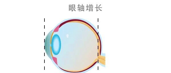 为什么近视不可逆？眼轴长度告诉你！