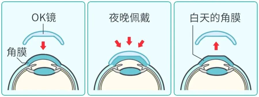 为什么近视不可逆？眼轴长度告诉你！