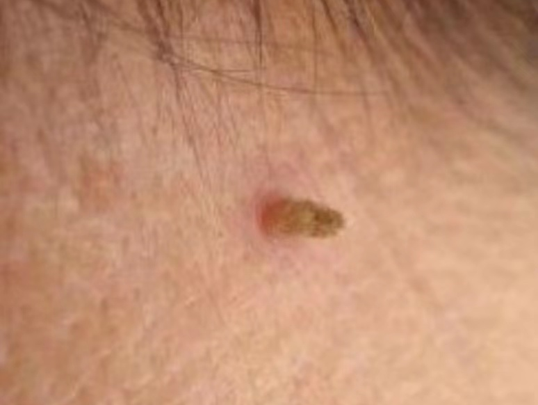 身上这种小肉揪,有些会传染,孕妈尤其要注意