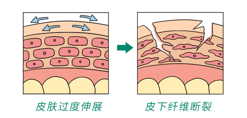 6种人易长妊娠纹,且年龄小反而易长!