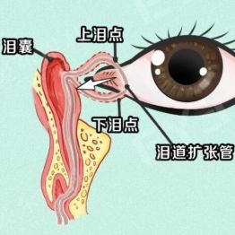 莫名流泪反反复复，拖久了可引发炎症！泪道问题要早查