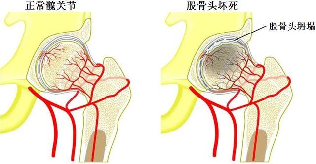 【人医科普】大腿根隐隐作疼别硬扛！警惕股骨头坏死找上门