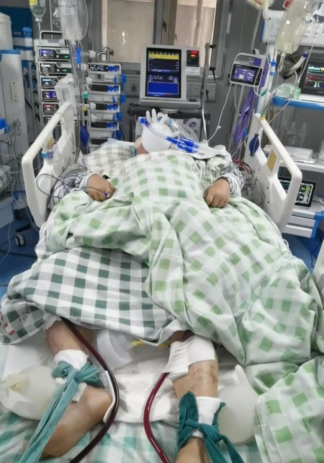 【聚焦临床前沿190】这种心梗更凶险,症状隐匿易漏诊!ECMO+中西医协同,成功救治高危右冠脉心梗休克患者