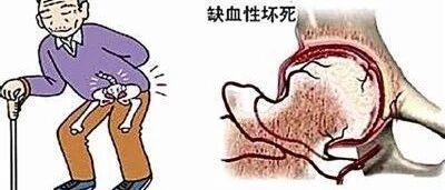 【人医科普】大腿根隐隐作疼别硬扛！警惕股骨头坏死找上门
