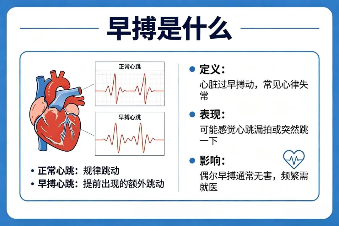 心律失常系列科普 | 心脏“咯噔”一下,是早搏吗?