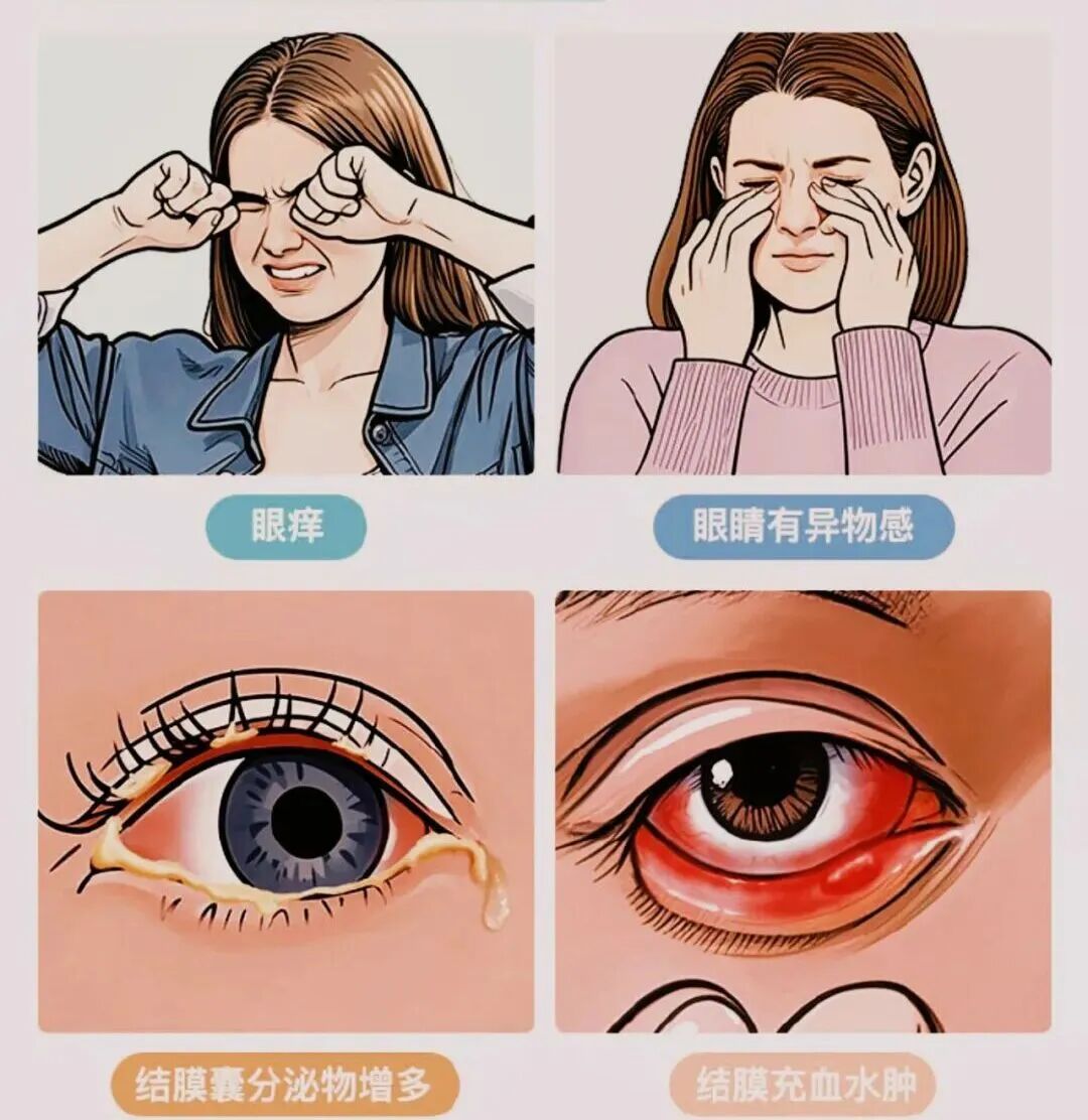 眼痒别乱揉 警惕过敏性结膜炎